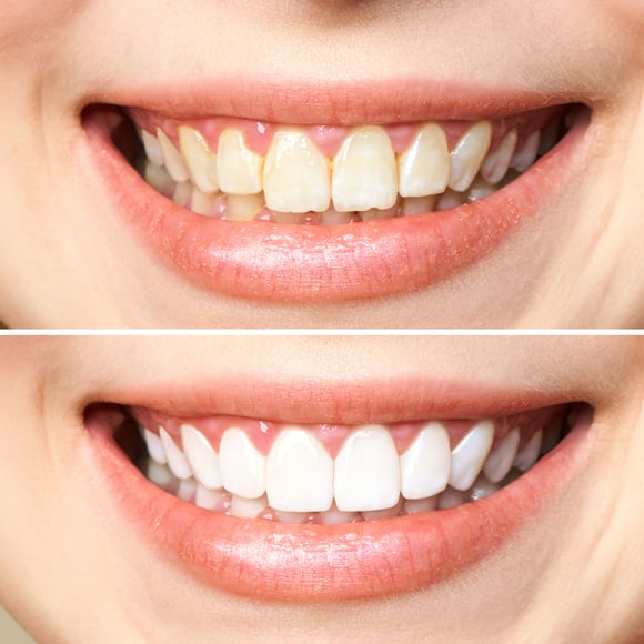 woman teeth before and after whitening. Over white background. Dental clinic patient. Image symbolizes oral care dentistry, stomatology